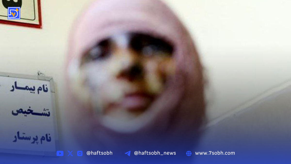 داغ اسید برادر بر چشمان خواهرش