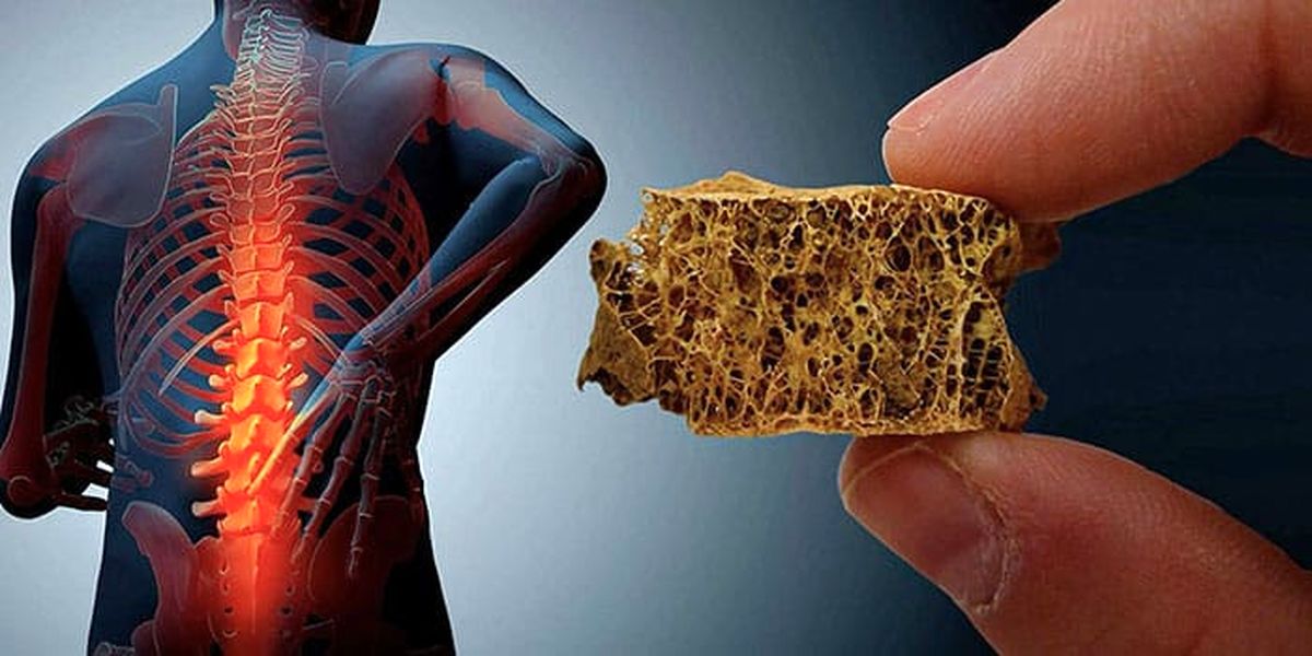 راهکاری طلایی جلوگیری از پوکی استخوان چیست؟