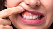 درمان سریع آفت دهان؛ معرفی ۱۰ راهکار موثر و درمان سریع