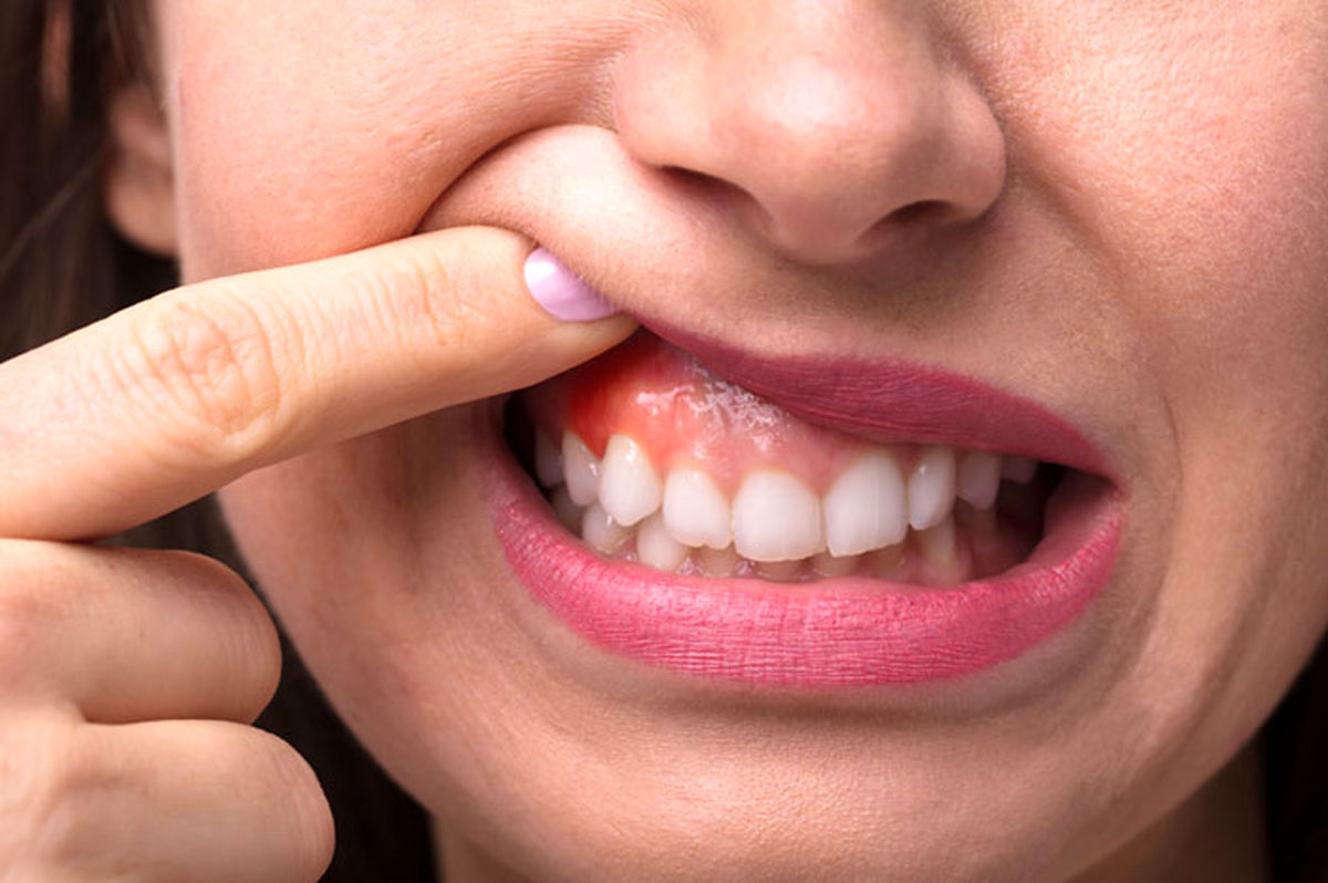 درمان سریع آفت دهان؛ معرفی ۱۰ راهکار موثر و درمان سریع