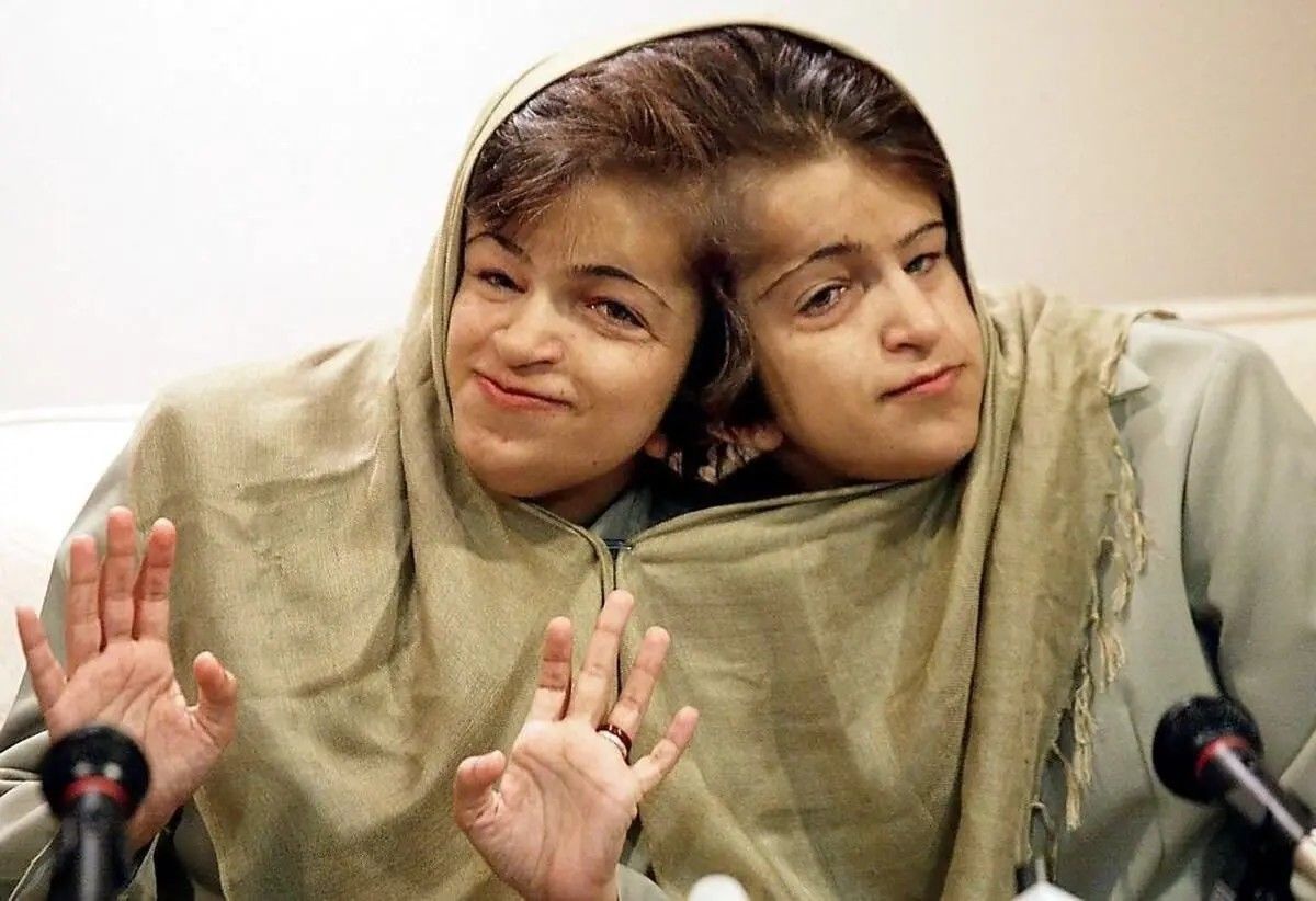 قاب تاریخ| ‌یادی از دوقلوهای به‌هم چسبیده لاله و لادن و عکس دیده نشده از فروغ فرخزاد