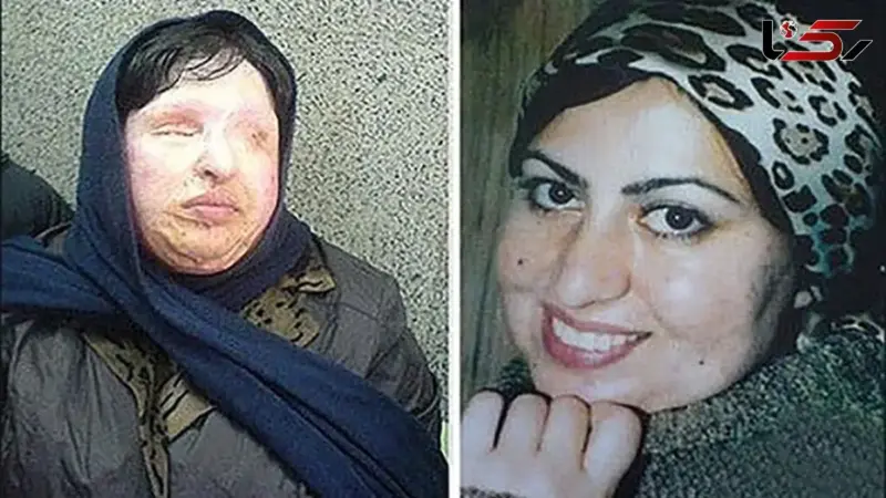 شکایت جدید آمنه بهرامی قربانی جنجالی ترین اسیدپاشی ایران بعد از 21 سال از پسر اسیدپاش / آمده ام تا …