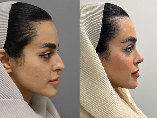 راز جراحی بینی طبیعی در تهران؛ معرفی ۱۰ جراح برتر که چهره‌ها را متحول کردند!