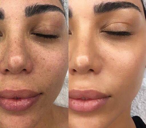 رازهای فیشیال در شمال تهران که پوست شما را متحول می‌کند!