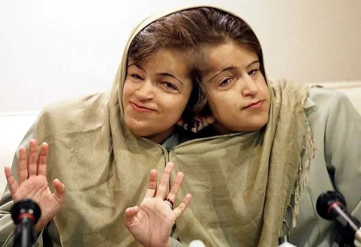 بیوگرافی لاله و لادن دوقلوهای به هم چسبیده دهه 60 ای