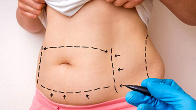 لیفت شکم و پهلو؛ راهکاری جراحی و بدون جراحی برای تغییر شگفت‌انگیز بدن شما
