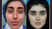 عمل بینی سربالا؛ زیبایی یا ریسک فرم غیرطبیعی؟ بررسی دقیق عمل ترمیم بینی خوکی