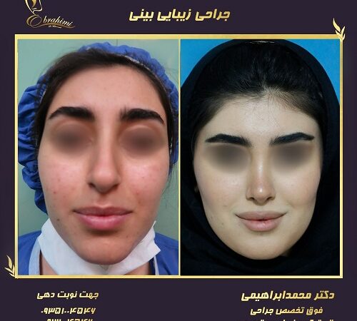 عمل بینی سربالا؛ زیبایی یا ریسک فرم غیرطبیعی؟ بررسی دقیق عمل ترمیم بینی خوکی