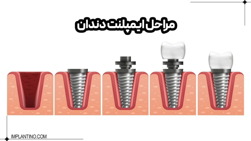 همه چیز درباره مراحل ایمپلنت دندان که باید حتما بدانید!