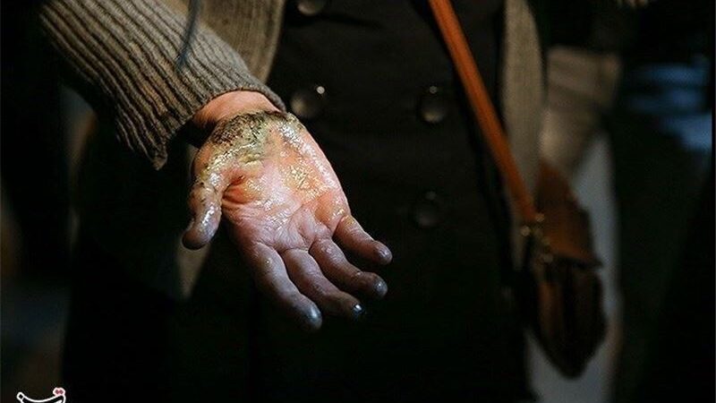 آمار تکان‌دهنده سوختگی در ایران؛ 300 هزار قربانی سالانه بدون تخت استاندارد دولتی!