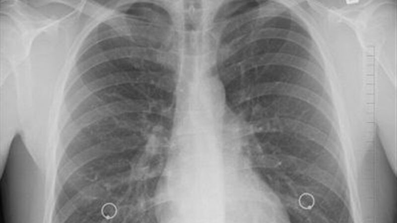 افزایش نگران‌کننده سرطان ریه در گلستان؛ تریاک چگونه 3.6 برابر خطر را بیشتر می‌کند؟