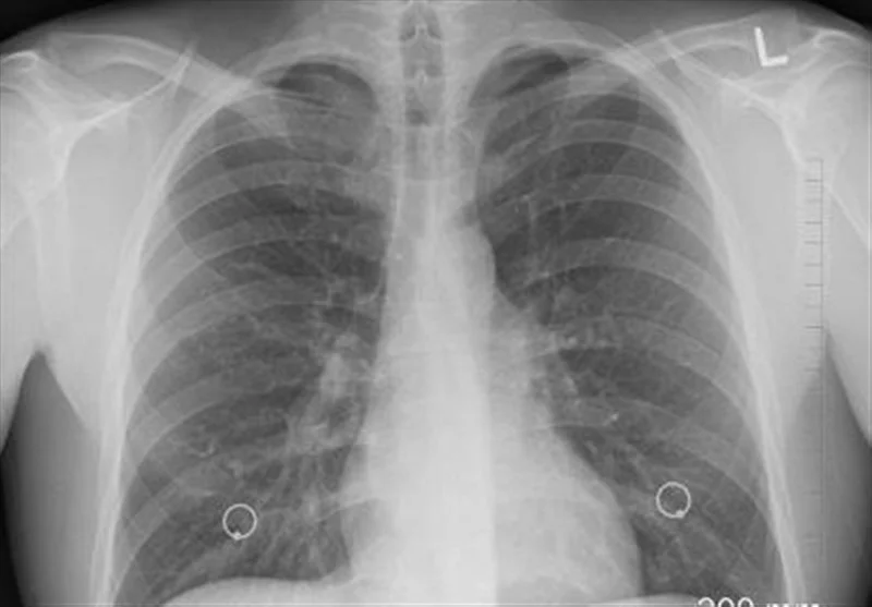 افزایش نگران‌کننده سرطان ریه در گلستان؛ تریاک چگونه 3.6 برابر خطر را بیشتر می‌کند؟