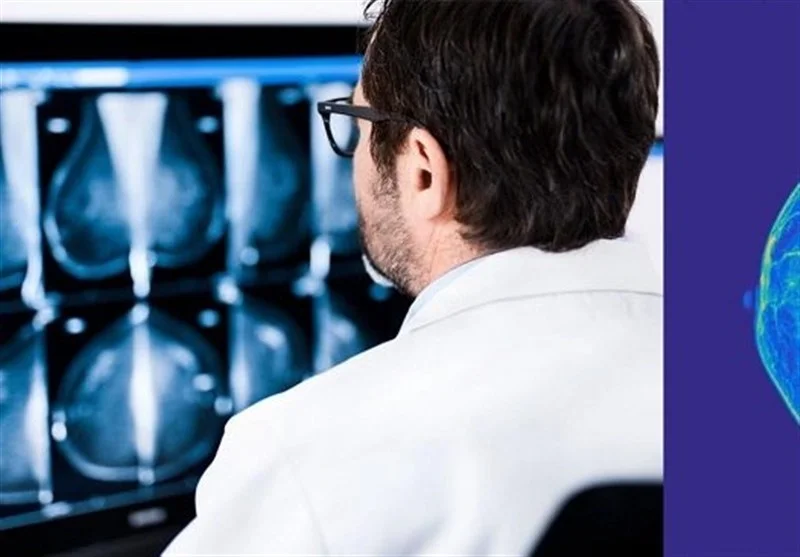 افزایش نگران‌کننده ۴ تا ۶ درصدی سرطان پستان در ایران؛ آیا ماموگرافی سالانه راه نجات است؟