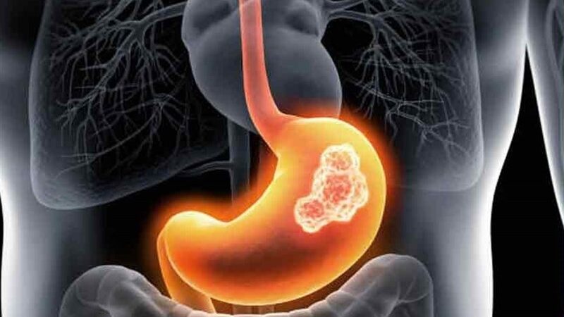 چرا وزارت بهداشت هنوز کیت‌های غربالگری سرطان‌های شایع گوارشی را در داروخانه‌ها توزیع نمی‌کند؟