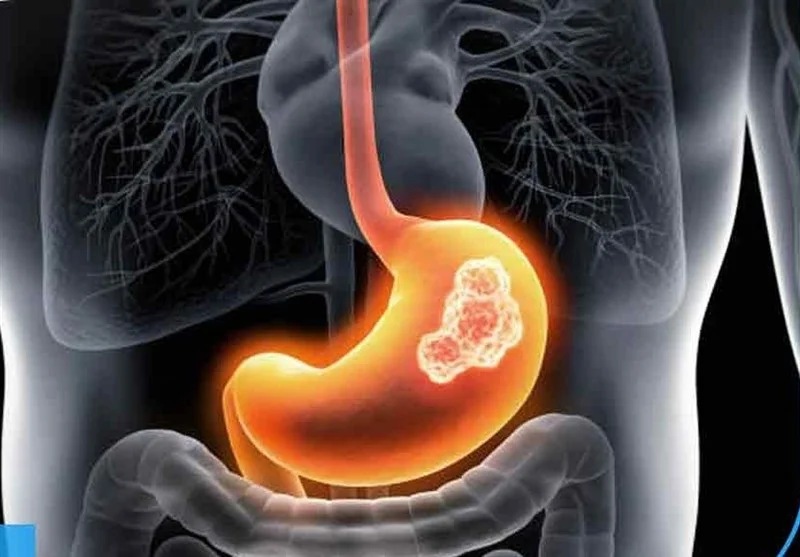 چرا وزارت بهداشت هنوز کیت‌های غربالگری سرطان‌های شایع گوارشی را در داروخانه‌ها توزیع نمی‌کند؟