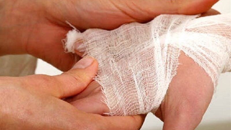 هزینه نجومی بستری بیماران سوختگی در بخش خصوصی؛ هر درصد سوختگی چقدر خرج برمی‌دارد؟