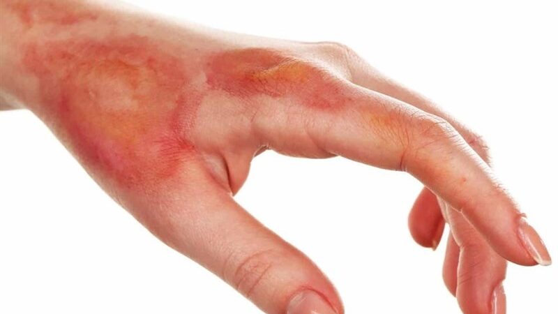 پیشروترین بیمارستان کشور در درمان سوختگی؛ بیش از نیمی از قربانیان نجات می‌یابند!