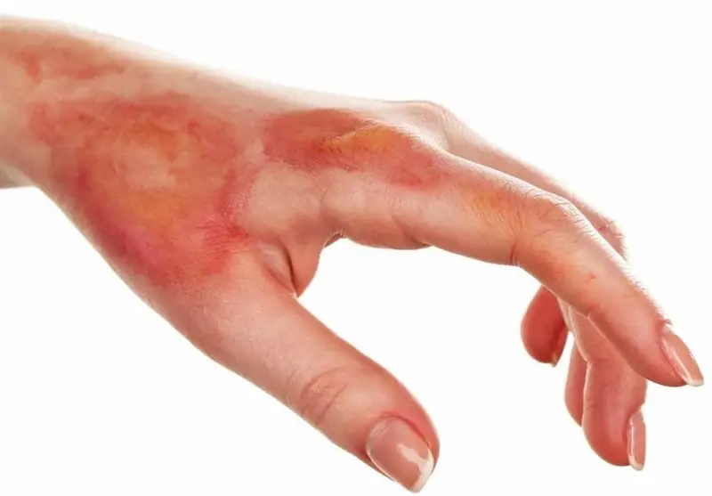 پیشروترین بیمارستان کشور در درمان سوختگی؛ بیش از نیمی از قربانیان نجات می‌یابند!