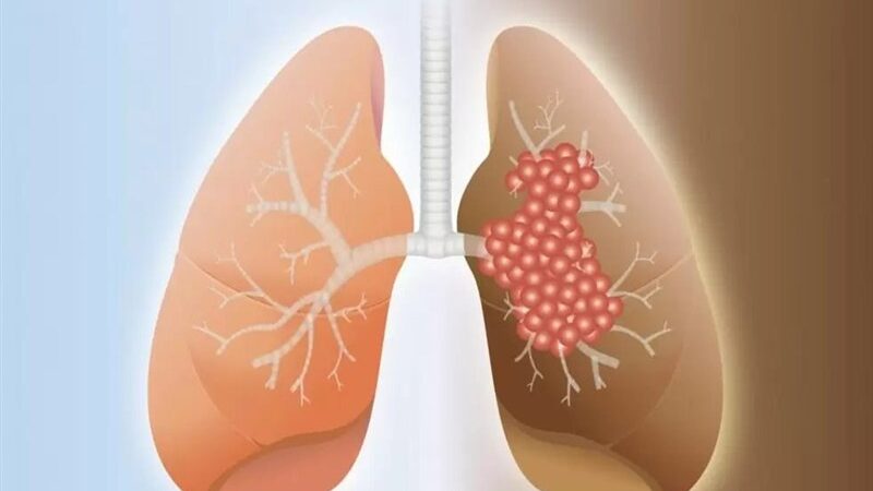 مهندسی معکوس داروی نجات‌بخش ریوی توسط متخصصان ایرانی؛ کاهش هزینه درمان از ۳۶۰ هزار دلار به ۳ هزار دلار!