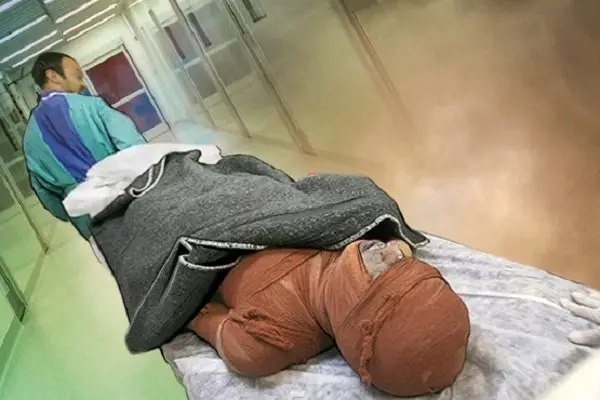 فاجعه کمبود هزار تخت سوختگی؛ بیماران در انتظار معجزه درمانی در کشور!