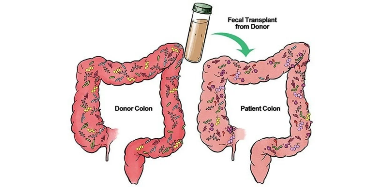 ایران در جمع پیشگامان درمان با پیوند مدفوع؛ انقلاب پزشکی که زندگی‌ها را دگرگون می‌کند!