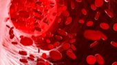 هشدار فوق تخصص خون: چرا تشخیص علت فقر آهن را نباید به تاخیر انداخت؟
