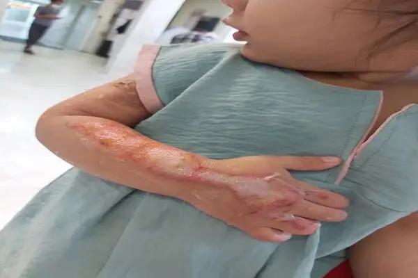 چگونه در یک لحظه از سوختگی‌های جبران‌ناپذیر جلوگیری کنیم؟ توصیه‌های طلایی فلوشیپ جراحی ترمیمی