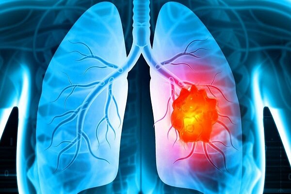 تحولی شگفت‌انگیز در درمان آسیب‌های سیگار بر میکروبیوم ریه با کمک پروبیوتیک‌ها