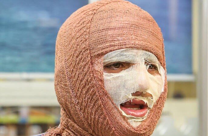 منطقه کاشان بیمارستان تخصصی سوختگی ندارد