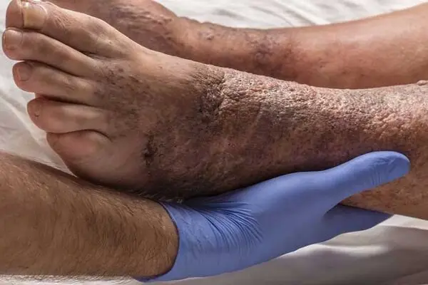 وقتی زخم بی‌حس می‌شود؛ علامت هشداردهنده پیشرفت دیابت که نباید نادیده گرفت!