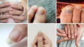 ۷ نشانه پنهان کلسترول بالا که ناخن‌هایتان فریاد می‌زنند!