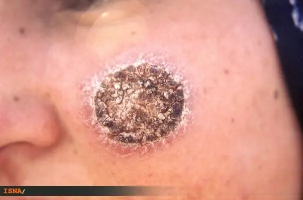 کاهش حیرت‌انگیز ۶۰ درصدی ابتلا به سالک در نطنز؛ راز موفقیت شبکه بهداشت چیست؟