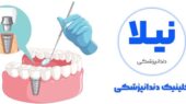 چرا تقاضای ایمپلنت دندان در تهران و کرج سر به فلک کشید؟ نیاز فوری به مراکز تخصصی شبانه‌روزی!