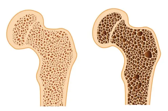 چگونه تغذیه نامناسب، استخوان‌هایتان را شکننده می‌کند؟ کشف حقایقی که نمی‌دانستید!