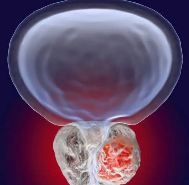 پروستات؛ غده‌ای کوچک با نقشی بزرگ در سلامت مردان