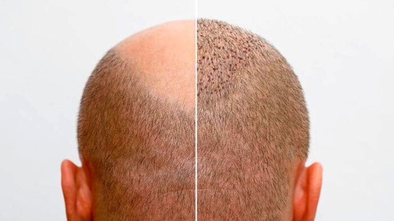 کشف ۱۰ کلینیک برتر کاشت مو در کرج؛ کدام مرکز بهترین نتایج را دارد؟