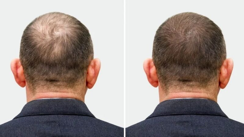 راز درمان شگفت‌انگیز ریزش مو با سلول‌های بنیادی فاش شد!