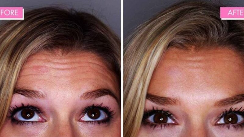 ۸ نکته حیاتی که هر بوتاکس اولی باید بداند!