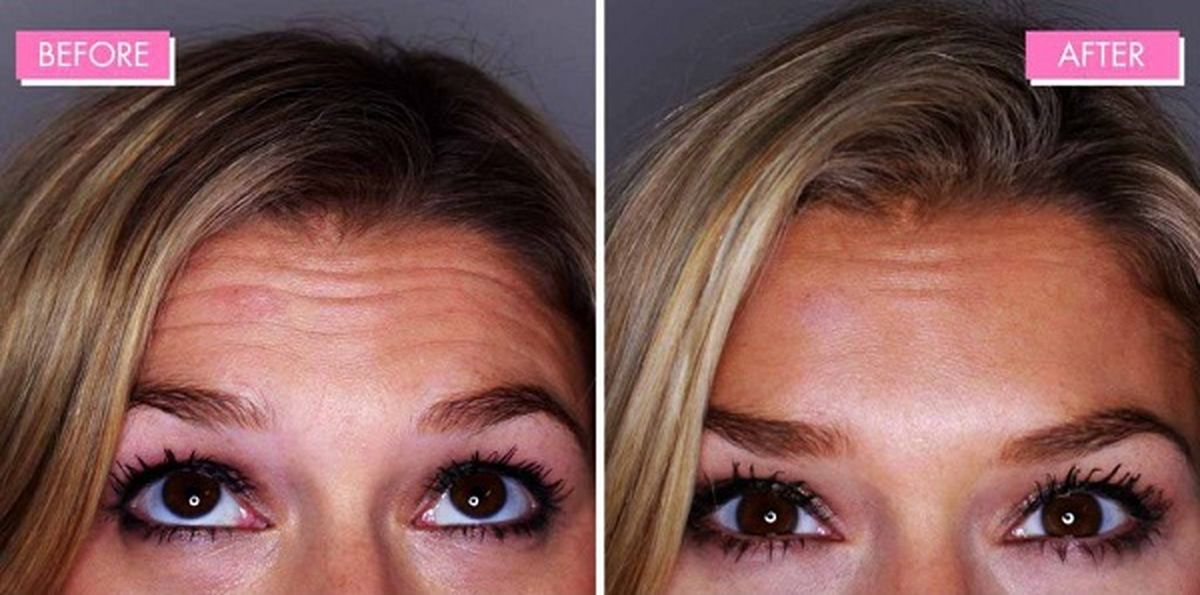 ۸ نکته حیاتی که هر بوتاکس اولی باید بداند!