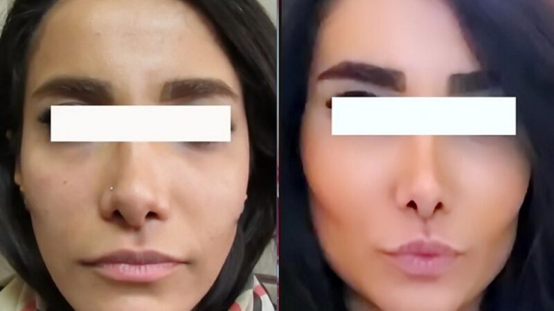 زاویه سازی فک؛ راهی نوین برای زیبایی بی‌نقص یا ریسک‌های پنهان؟