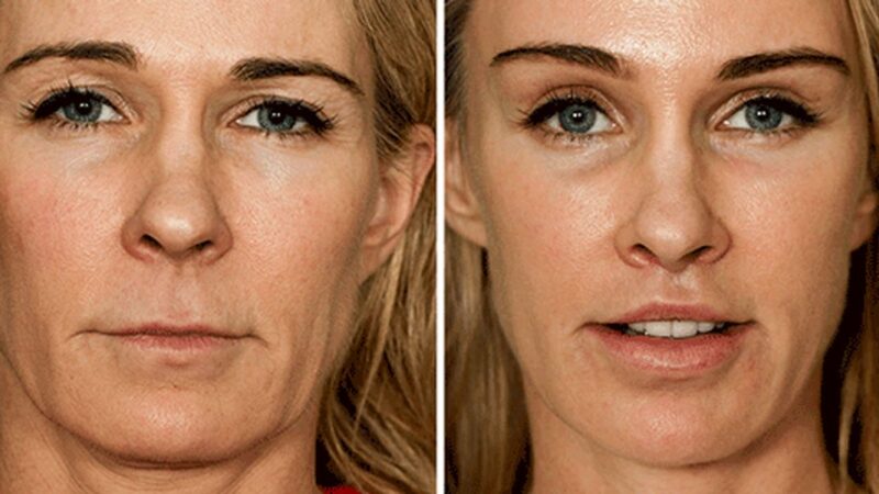 لیفت شقیقه؛ راز جوانی و زیبایی بدون جای زخم که باید بدانید!