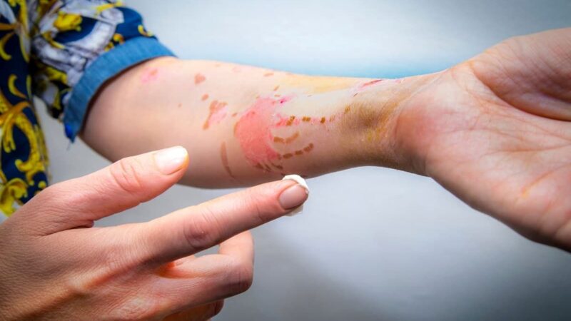 ترمیم معجزه‌آسای جای زخم‌های قدیمی با سلول‌های بنیادی؛ حقیقتی که باید بدانید!