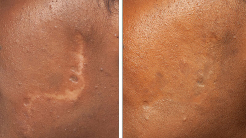 درمان زخم با سلول‌های بنیادی یا لیزر؛ کدام راه‌حل، معجزه‌گرتر است؟