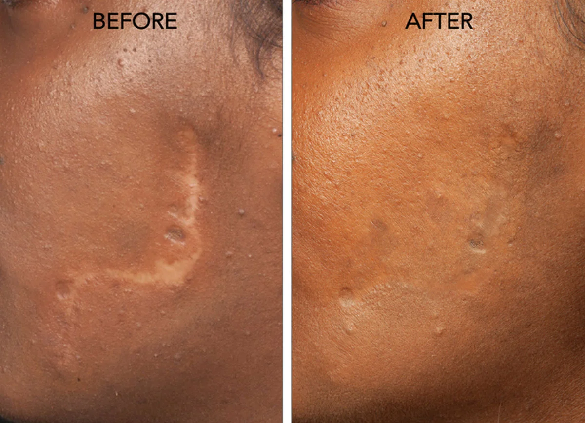 درمان زخم با سلول‌های بنیادی یا لیزر؛ کدام راه‌حل، معجزه‌گرتر است؟