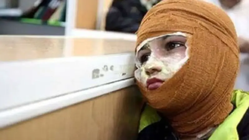 قیمت لباس‌های سوختگی از ۲ تا ۴۰ میلیون تومان؛ چرا درمان بیماران زیر ذره‌بین بیمه‌هاست؟