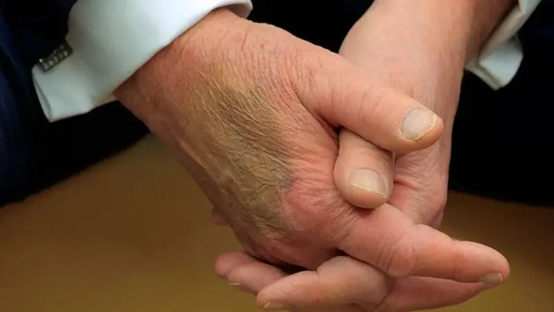 جدال داغ بر سر سلامتی ترامپ؛ واقعیت خستگی یا بازی رسانه‌ای؟