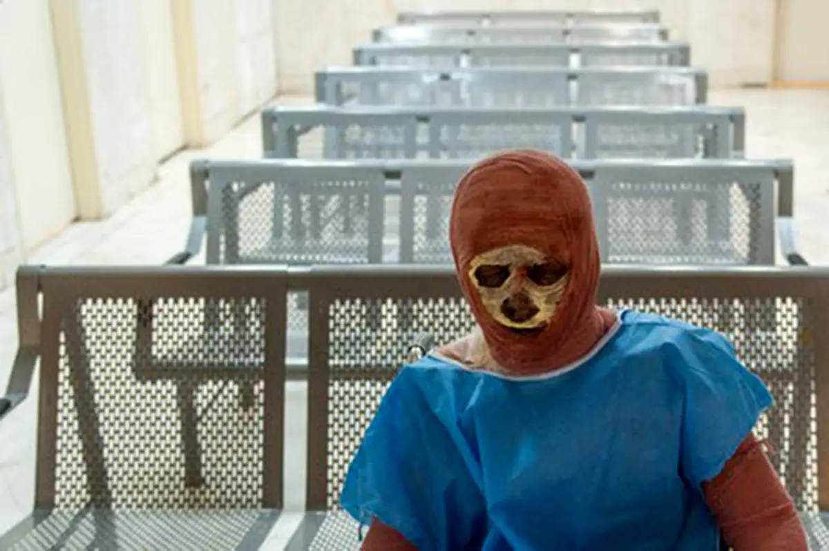 شوک قیمت لباس سوختگی در ایران؛ هزینه‌ای نجومی که بیماران را زمین‌گیر کرد!