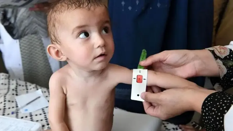 واریز دو مرحله یارانه رفع سوءتغذیه کودکان زیر ۵ سال